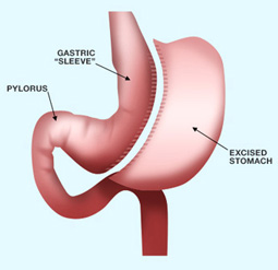 © Ethicon Endo-Surgery