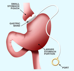 © Ethicon Endo-Surgery