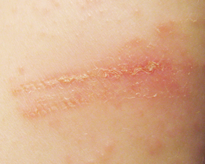 Contact dermatitis