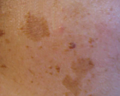 melasma