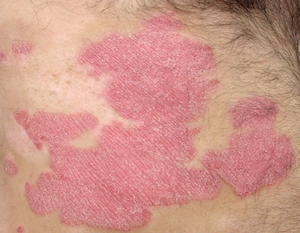 Psoriasis