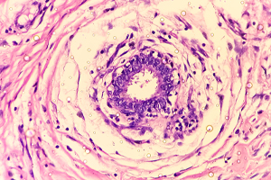 Hidradenitis suppurativa under the microscope (c) UC Regents. All rights reserved.