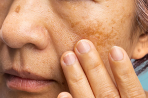 Melasma on a person's skin (c) UC Regents. All rights reserved.