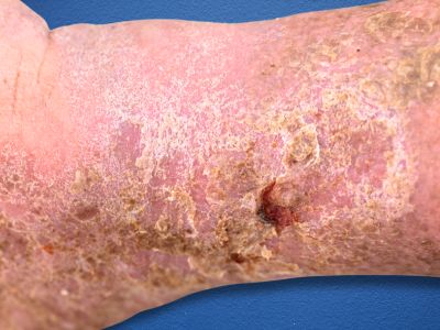 Scaly skin lesions on an arm (c) UC Regents. All rights reserved.