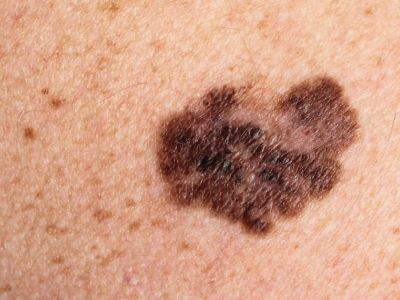 Melanoma on the skin (c) UC Regents. All rights reserved.