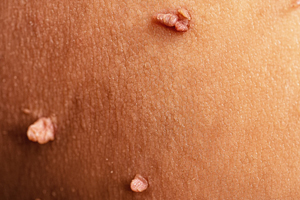 Skin tags on a person (c) UC Regents. All rights reserved.