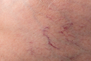 Spider veins on skin (c) UC Regents. All rights reserved.