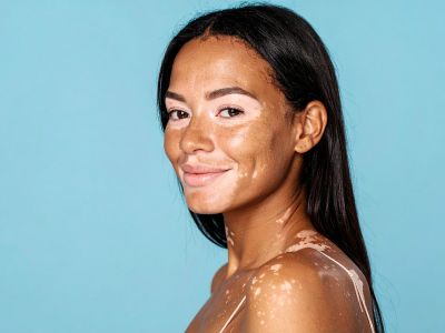Woman with vitiligo (c) UC Regents. All rights reserved.