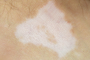 Vitiligo