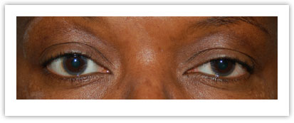 ptosis repair