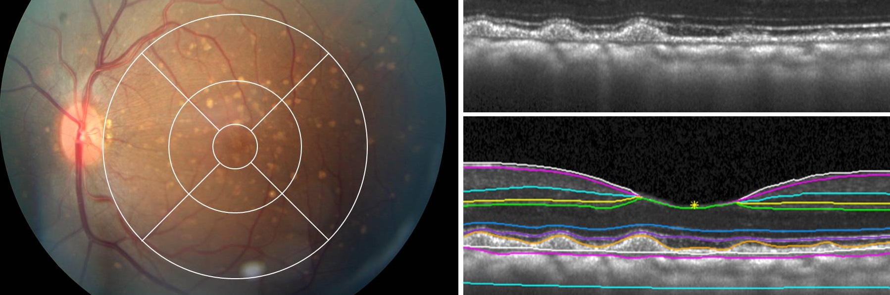 Imaging in Retinal Disease