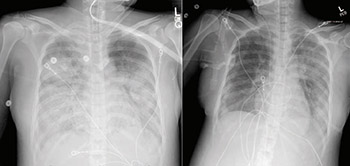 index patient chest scan