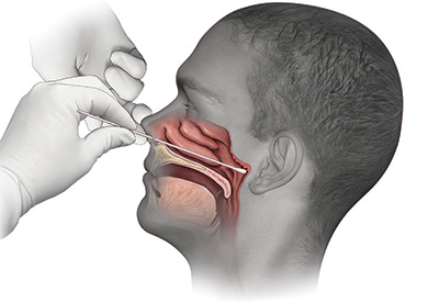 An illustration of the swab test distributed by UC Davis Health trended nationally in the early pandemic, ranking high on search engines.