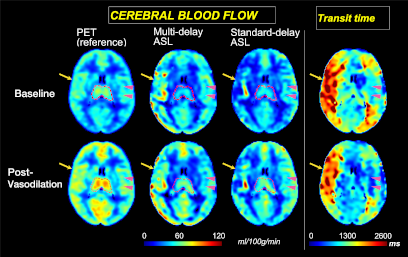 Cerebral Blood Flow