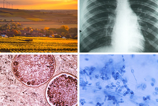 valley fever
