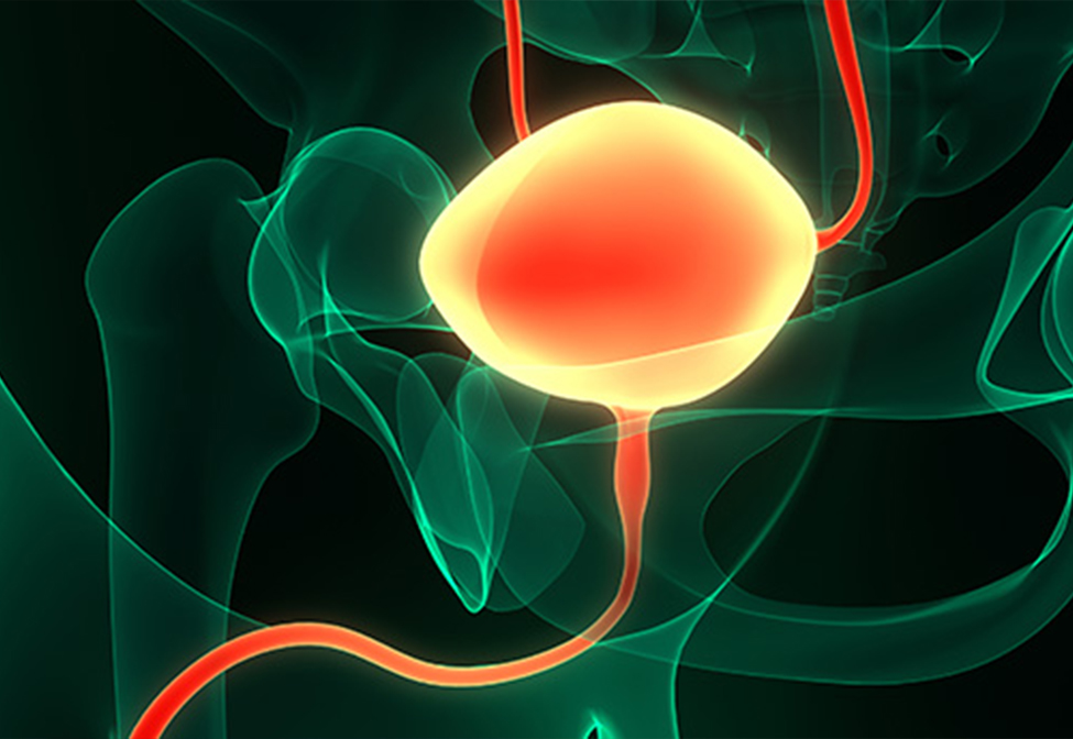 UC Davis Launches First Regional Bladder Cancer Trial