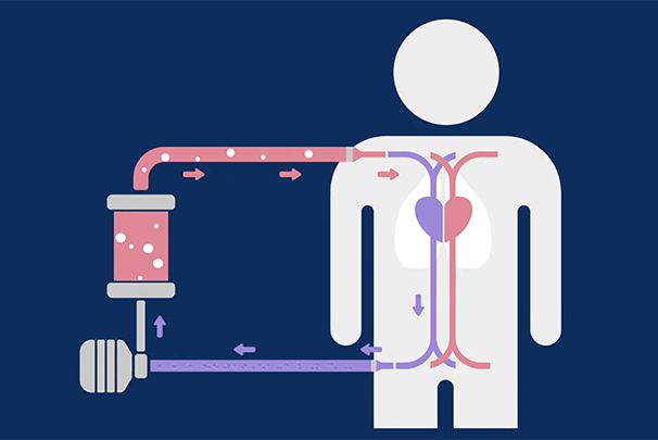 Diagram of how ECMO machine works