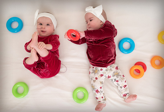 Conjoined twins who were separated.