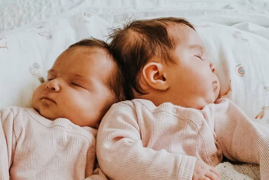 Twins Abigail and Micaela connected at the head.