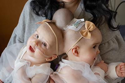 Twins Abigail and Micaela connected at the head.