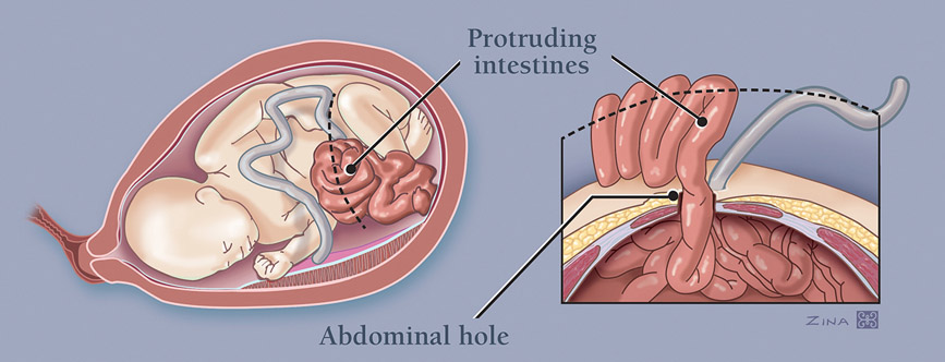 3_Gastroschisis.jpg