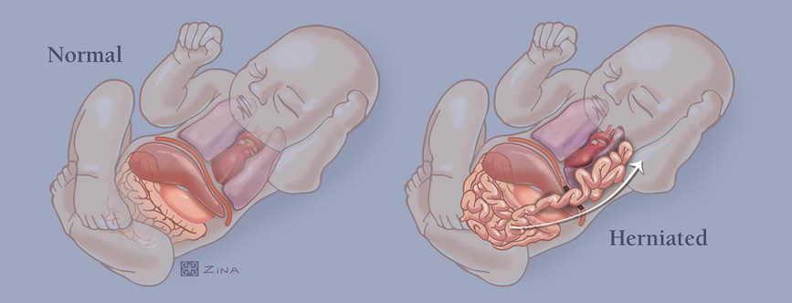 Diaphragmatic_hernia.jpg