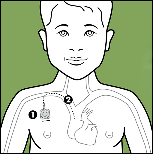 boy with Port a catheter 