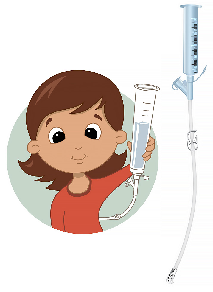 Bolus Feeding with Syringe