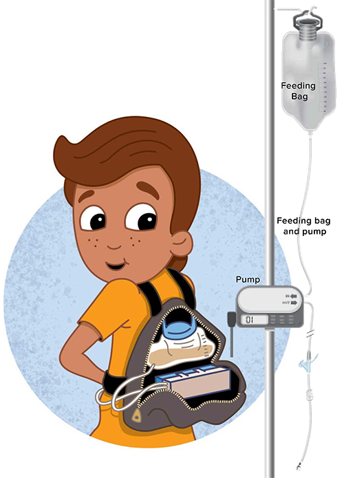 Enteral Pump Feeding