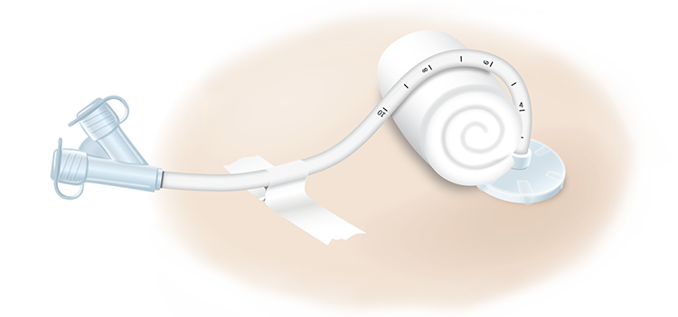 Home care for PEG tube