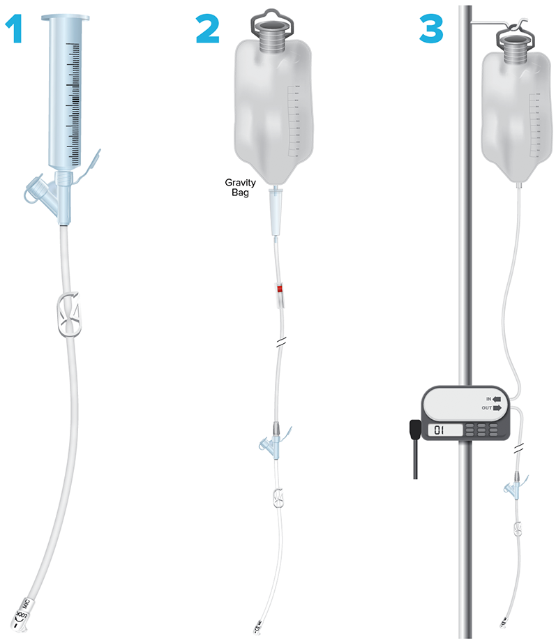 three ways that tube feedings: bolus by gravity with syringe, bolus by gravity with a feeding bag and bolus, continuous or cycled by pump with a feeding bag
