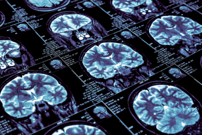 A series of brain scans are shown on a screen.