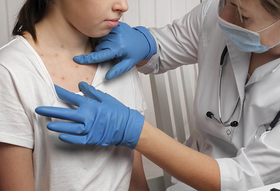 Healthcare worker checking the skin of a young girl with Chickenpox.