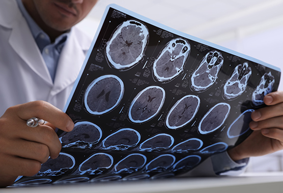 Neurologist examining MRI for neuroimmunological disorders.