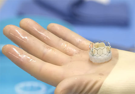 tavr procedure