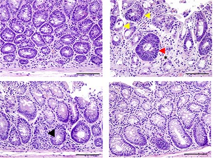 Effect of dual cytokine blockade treatment on cell death in the gut