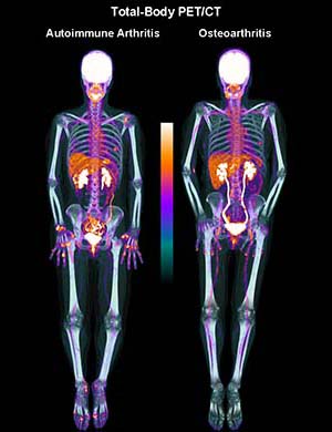 Scan of entire body with lit images indicating inflammation