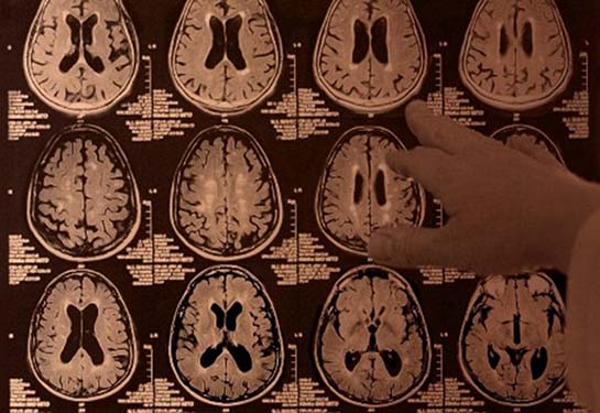 A hand points at a series of MRI images of the human brain.