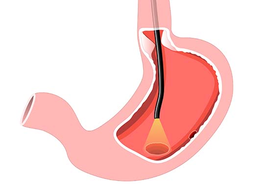 Stomach with endoscope