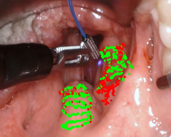 FLIm technology integrated to TORS to detect cancerous tissues