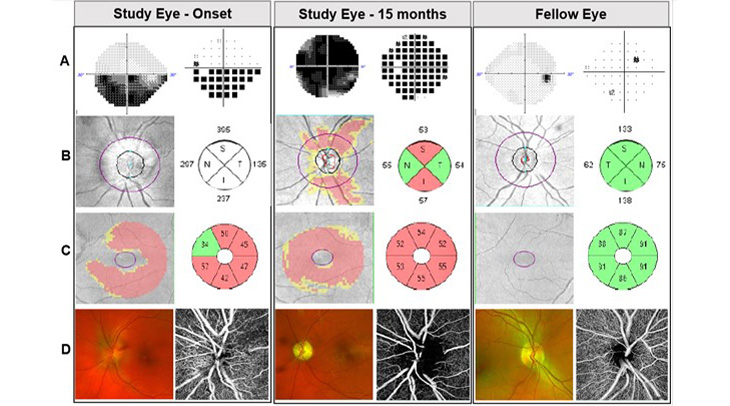 A grid of images showing digital images with the bottom row showing red images of the optic disks compared to a healthier image that is less red.