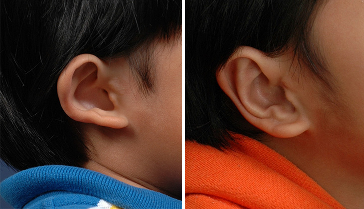 Ear before and after composite 