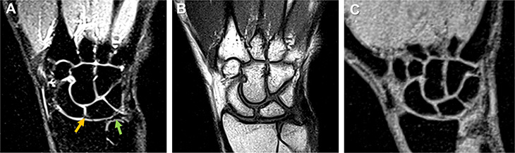 Black and white MRI scans of a person’s wrist and lower arm