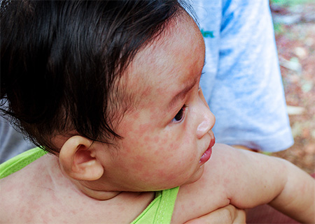 Child with measles