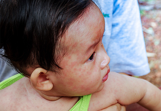 Child with measles