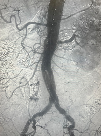 Black and white x-ray of aorta weaving like tree branches