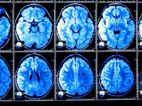 Multiple images of an MRI (magnetic resonance imaging) of a human head.