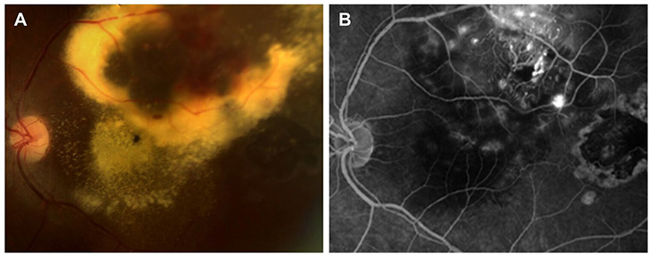 Left image shows yellow lipid against a dark background; the black-and-white image on the right shows leaking blood vessels.