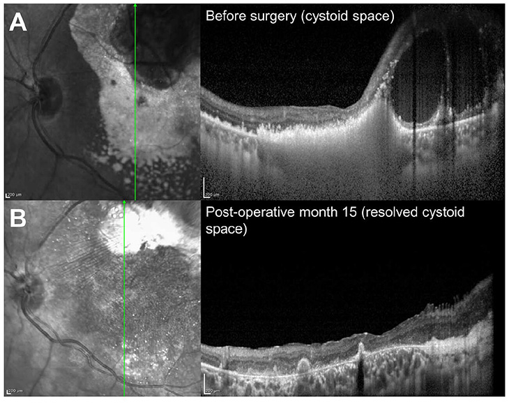 Four black and white images show scans of the retina before and after surgery.