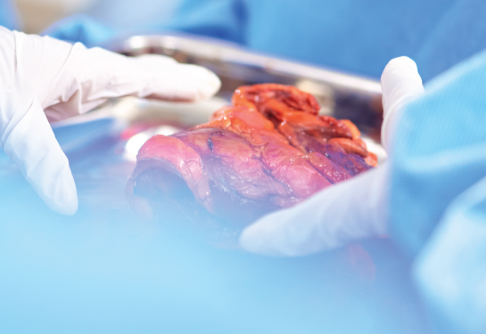 Hands with blue medical gloves near human liver organ resting on table.